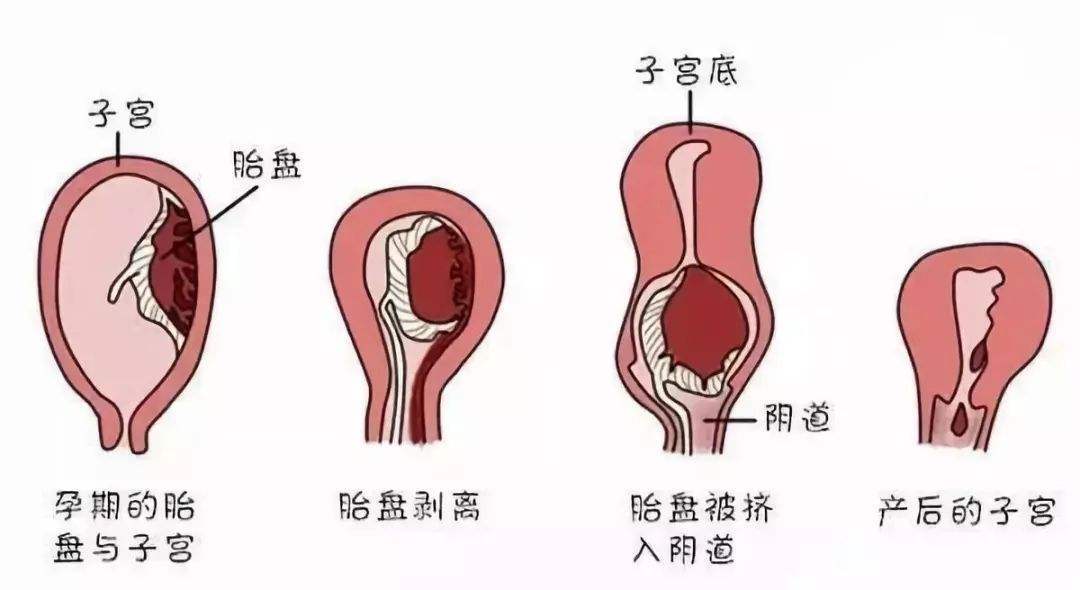 几个月剖腹产，产后恢复与身体调理的全方位解析